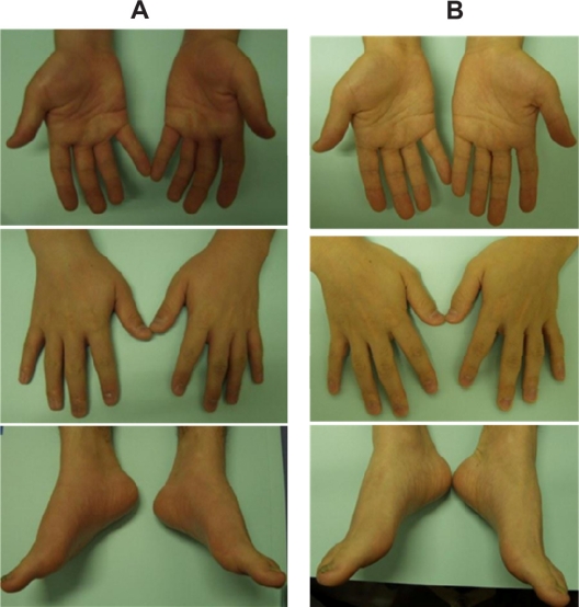 Edematous erythema at the hands and feet probably caused by the traditional herb "radix astragali".
