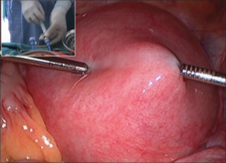 Laparoscopic myomectomy with aquadissection and barbed sutures.