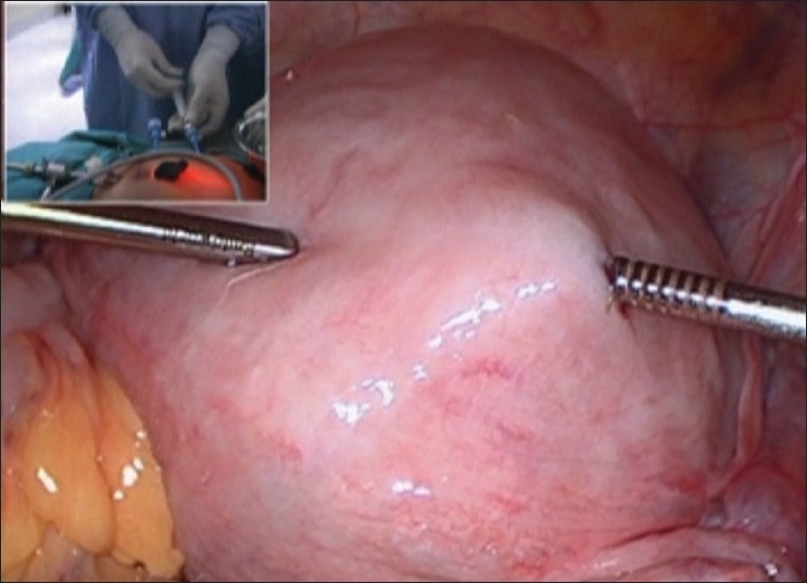 Laparoscopic myomectomy with aquadissection and barbed sutures.