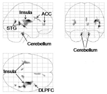 Smaller regional gray matter volume in homeless african american cocaine-dependent men: a preliminary report.