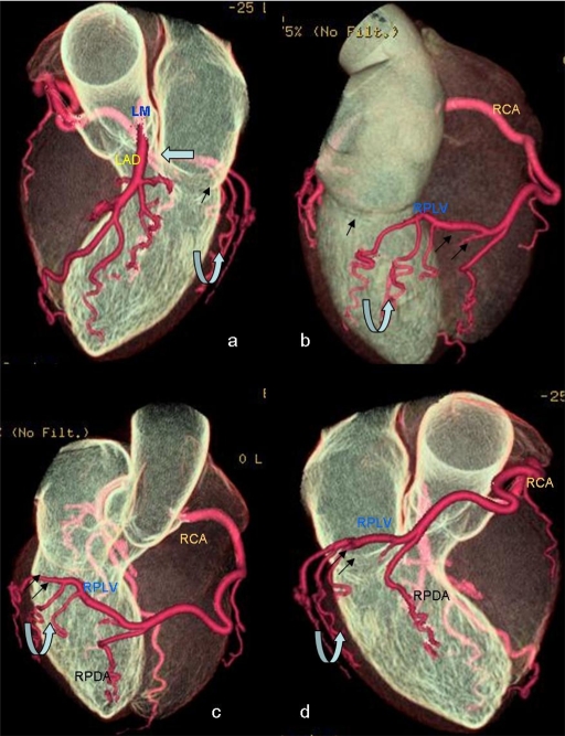 Superdominant right coronary artery with absent left circumflex artery.
