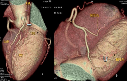 Superdominant right coronary artery with absent left circumflex artery.