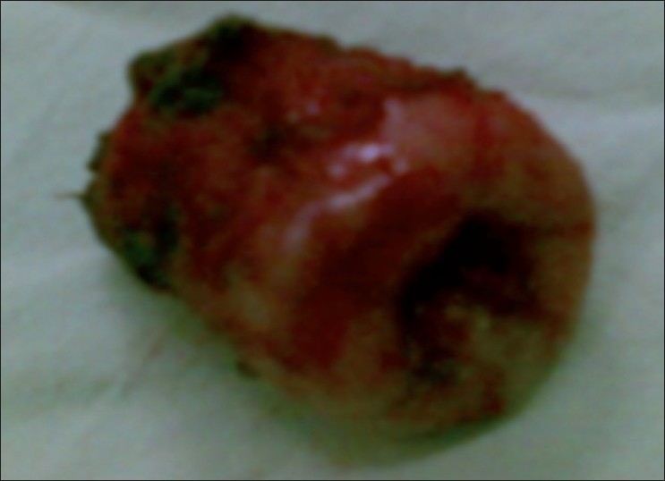 Laparoscopic Trachelectomy for Cervical Stump 'Carcinoma in situ'.