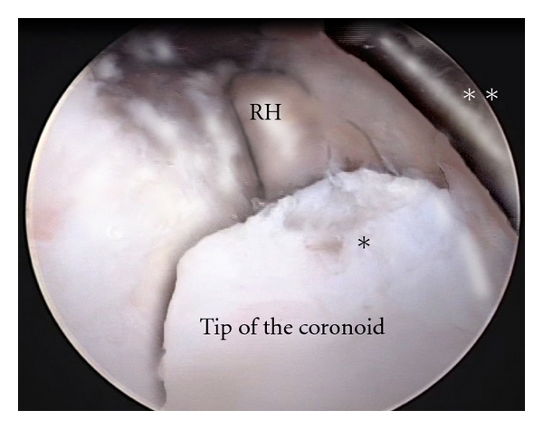 Arthroscopic treatment of stiff elbow.