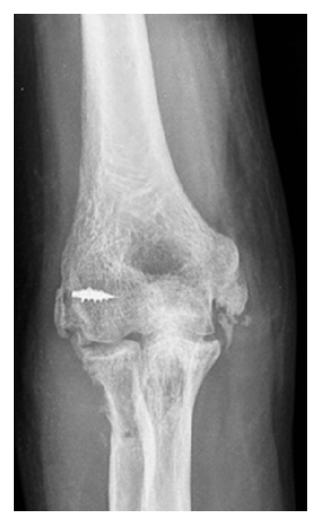 Arthroscopic treatment of stiff elbow.