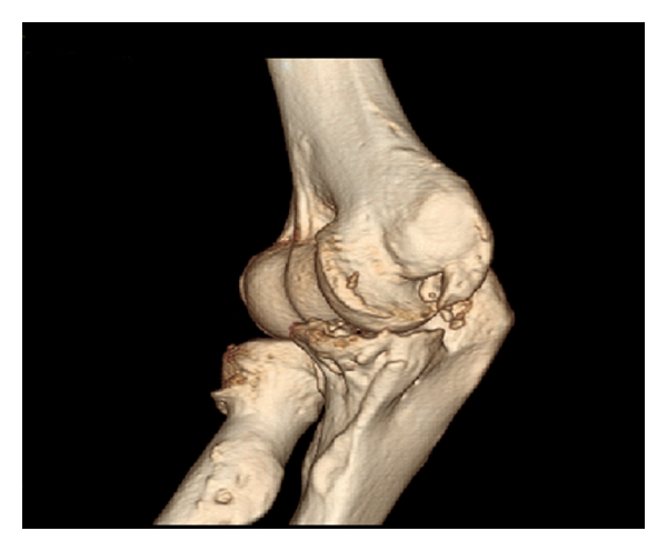 Arthroscopic treatment of stiff elbow.