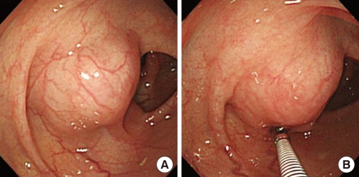 Recurrent renal leiomyosarcoma mimicking a colonic submucosal tumor: a case report.