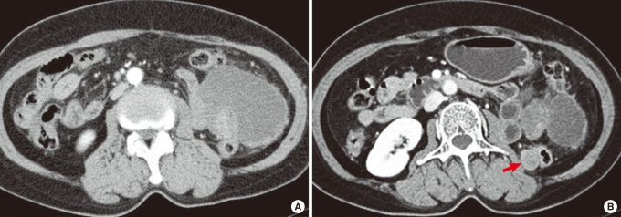 Recurrent renal leiomyosarcoma mimicking a colonic submucosal tumor: a case report.