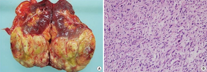 Recurrent renal leiomyosarcoma mimicking a colonic submucosal tumor: a case report.