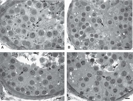 The role of asynapsis in human spermatocyte failure