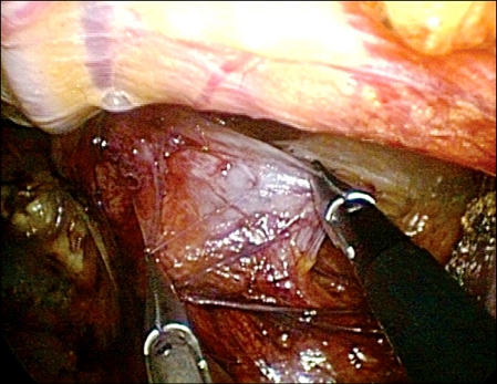 Initial experience of single port laparoscopic totally extraperitoneal hernia repair: nearly-scarless inguinal hernia repair.