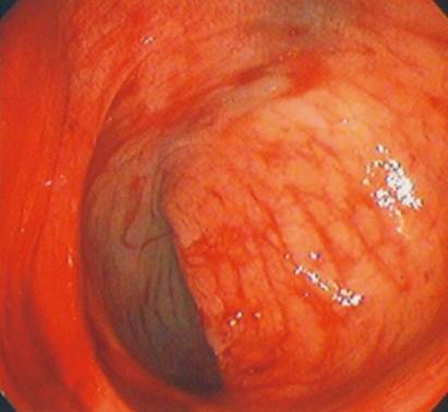 A case of successful colonoscopic treatment of acute appendiceal bleeding by endoclips.