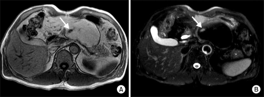 Histologic confirmation of huge pancreatic lipoma: a case report and review of literatures.