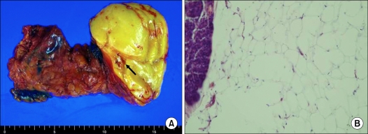 Histologic confirmation of huge pancreatic lipoma: a case report and review of literatures.