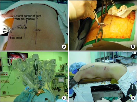 Robot-assisted posterior retroperitoneoscopic adrenalectomy: single port access.