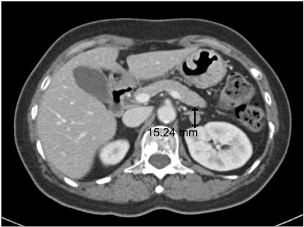 Robot-assisted posterior retroperitoneoscopic adrenalectomy: single port access.