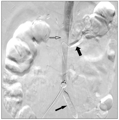 Successful hybrid operation of an acute mobile thrombus in the abdominal aorta induced by chemotherapy.