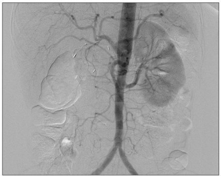 Successful hybrid operation of an acute mobile thrombus in the abdominal aorta induced by chemotherapy.