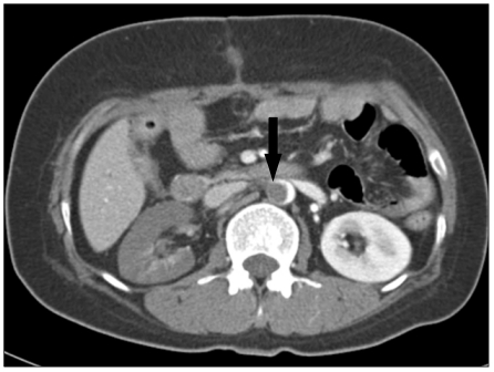 Successful hybrid operation of an acute mobile thrombus in the abdominal aorta induced by chemotherapy.