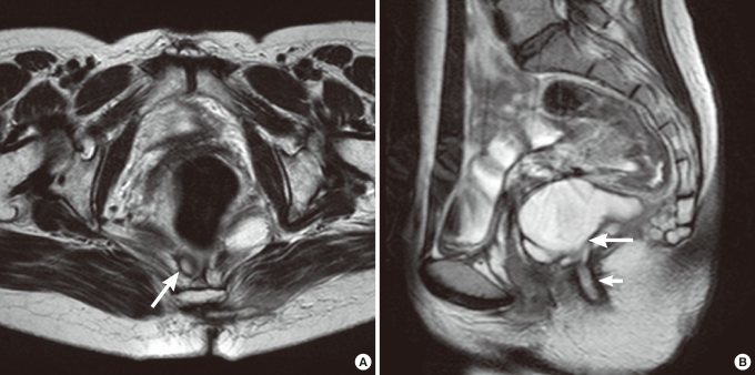 Clinical Study and Review of Articles (Korean) about Retrorectal Developmental Cysts in Adults.