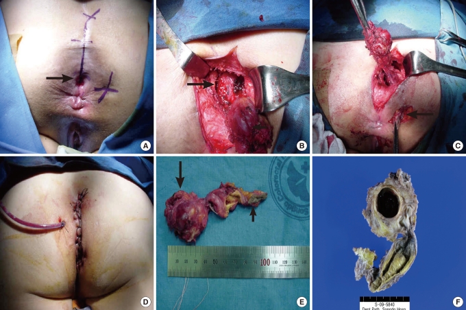 Clinical Study and Review of Articles (Korean) about Retrorectal Developmental Cysts in Adults.