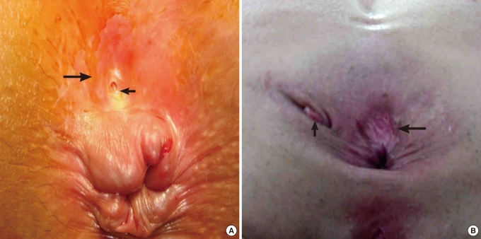 Clinical Study and Review of Articles (Korean) about Retrorectal Developmental Cysts in Adults.