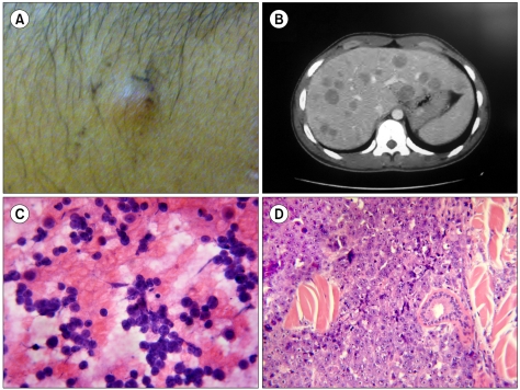 HIV-associated plasmablastic lymphoma diagnosed by fine-needle aspiration cytology.