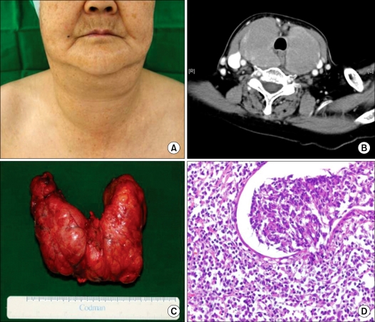 Primary thyroid mucosa-associated lymphoid tissue lymphoma; a clinicopathological study of seven cases.