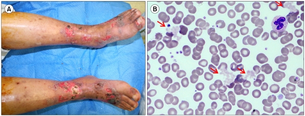 Cryoglobulinemic vasculitis and monoclonal gammopathy in end-stage renal disease.