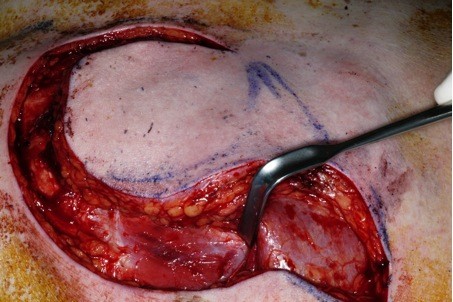 Evaluation of the pectoralis major flap for reconstructive head and neck surgery.