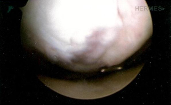 Combined autologous chondrocyte implantation (ACI) with supra-condylar femoral varus osteotomy, following lateral growth-plate damage in an adolescent knee: 8-year follow-up.