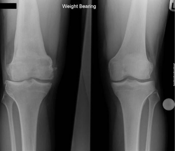 Combined autologous chondrocyte implantation (ACI) with supra-condylar femoral varus osteotomy, following lateral growth-plate damage in an adolescent knee: 8-year follow-up.