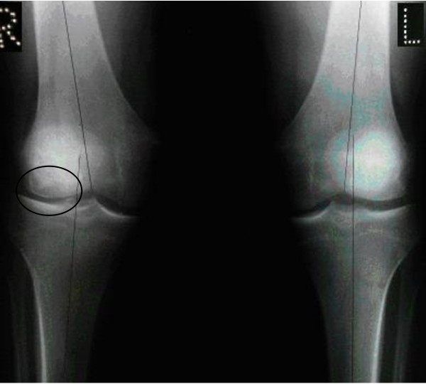 Combined autologous chondrocyte implantation (ACI) with supra-condylar femoral varus osteotomy, following lateral growth-plate damage in an adolescent knee: 8-year follow-up.