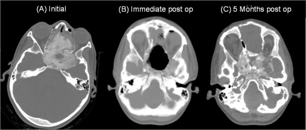 Fibrous dysplasia and aneurysmal bone cyst of the skull base presenting with blindness: a report of a rare locally aggressive example.