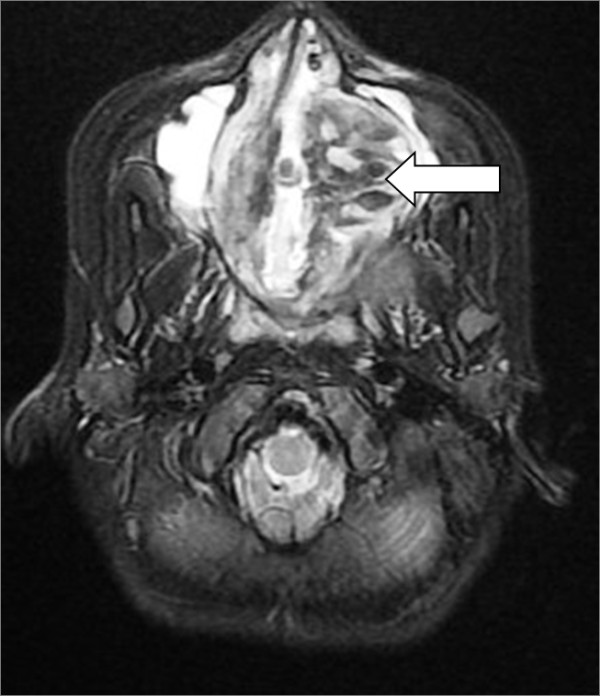 Fibrous dysplasia and aneurysmal bone cyst of the skull base presenting with blindness: a report of a rare locally aggressive example.