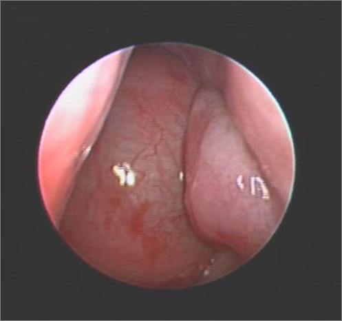 Fibrous dysplasia and aneurysmal bone cyst of the skull base presenting with blindness: a report of a rare locally aggressive example.