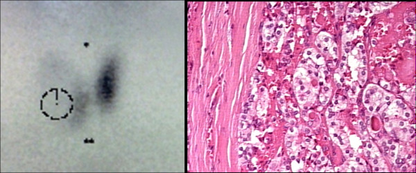 Role of ultrasound, clinical and scintigraphyc parameters to predict malignancy in thyroid nodule.