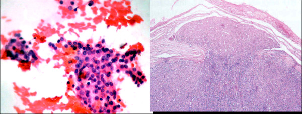 Role of ultrasound, clinical and scintigraphyc parameters to predict malignancy in thyroid nodule.