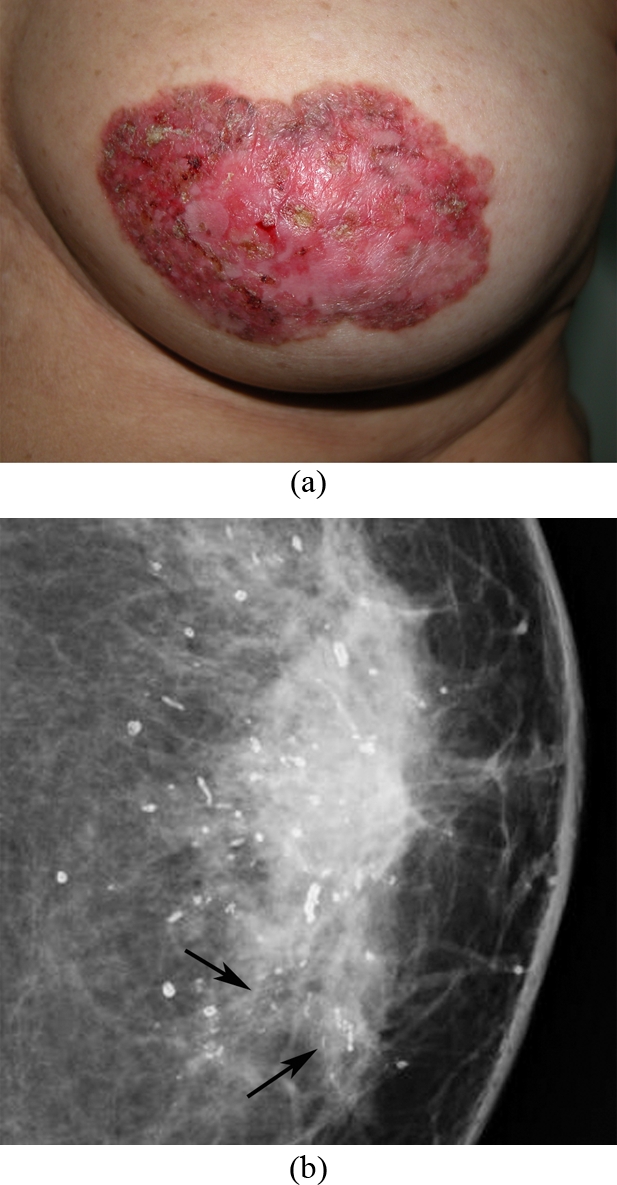 Paget's disease of the breast: clinical, imaging and pathologic findings: a review of 16 patients.