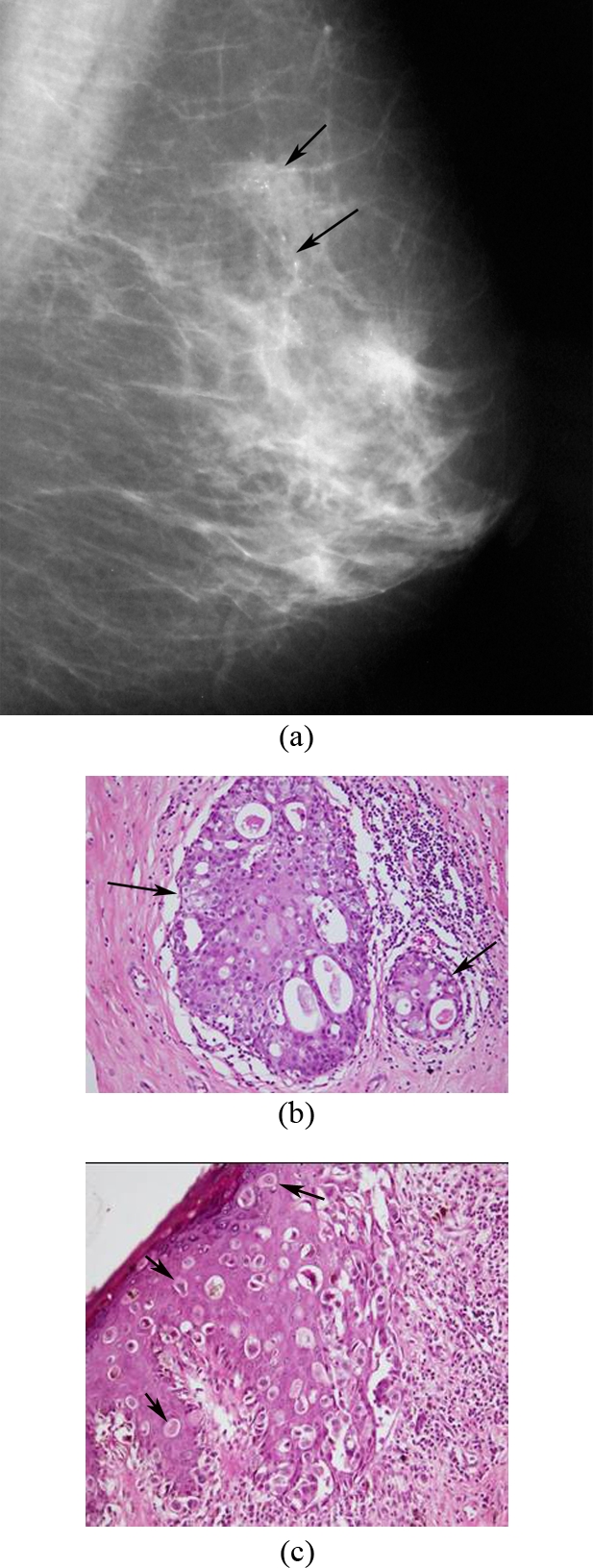 Paget's disease of the breast: clinical, imaging and pathologic findings: a review of 16 patients.