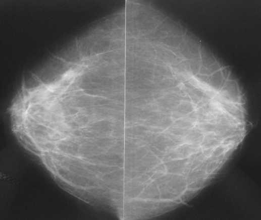 Paget's disease of the breast: clinical, imaging and pathologic findings: a review of 16 patients.
