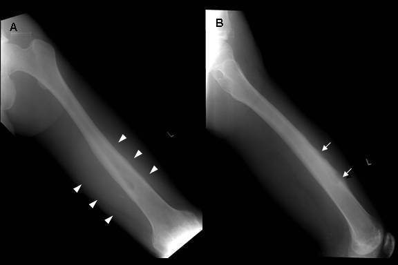 Radiofrequency ablation of a misdiagnosed Brodie's abscess.
