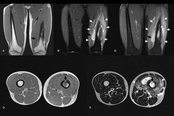 Radiofrequency ablation of a misdiagnosed Brodie's abscess.