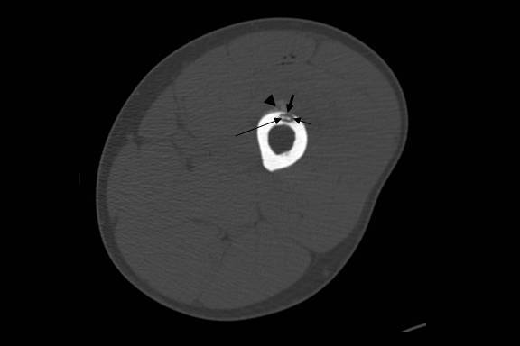 Radiofrequency ablation of a misdiagnosed Brodie's abscess.