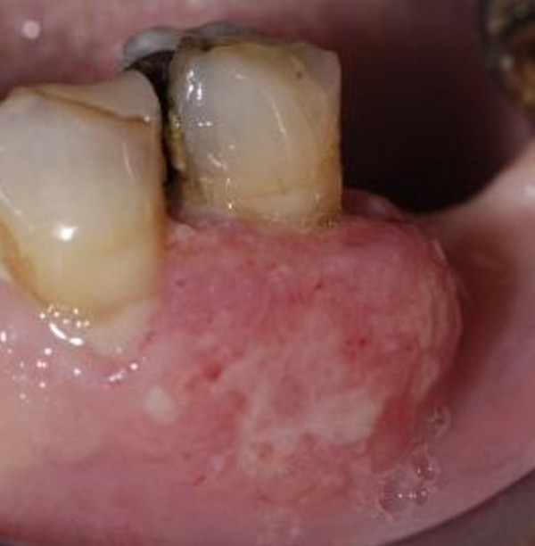 A case report of metastasis of malignant mesothelioma to the oral gingiva.