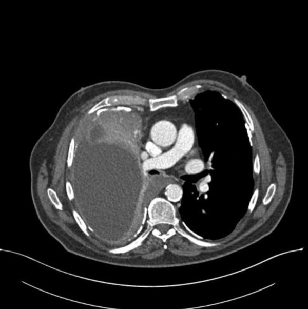 A case report of metastasis of malignant mesothelioma to the oral gingiva.