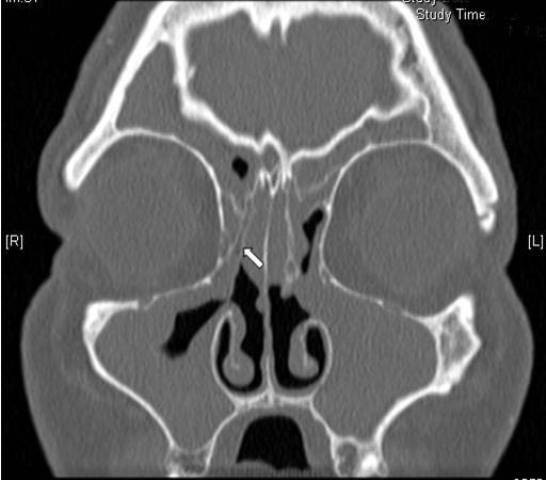 Radiological findings in patients undergoing revision endoscopic sinus surgery: a retrospective case series study.