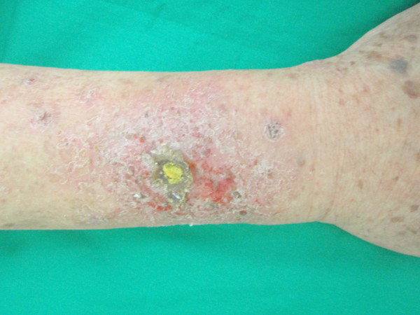 Contact dermatitis presenting as non-healing wound: case report.