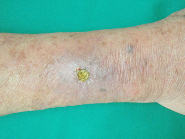 Contact dermatitis presenting as non-healing wound: case report.