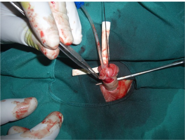 Mathieu repair of distal and midshaft hypospadias: risks and benefits of foreskin reconstruction versus circumcision.